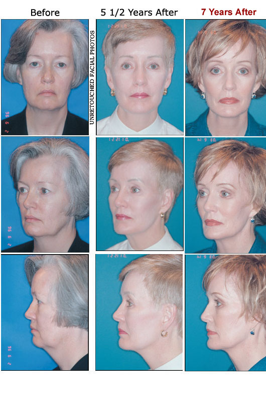 Barbara Moles before and after