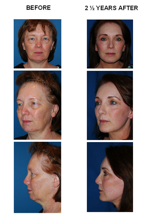 Judy Angle before and after