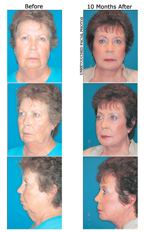 Kay Whitt before and after