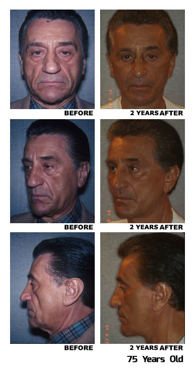 Facelift before and after photo, patient Nick