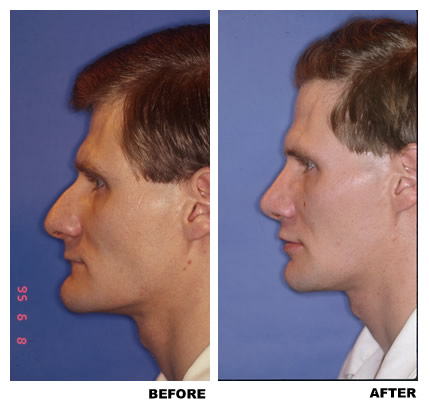 Rhinoplasty before and after photo, patient 2
