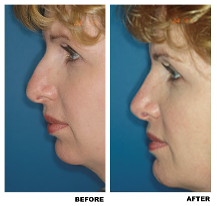 Rhinoplasty before and after photo, patient 3