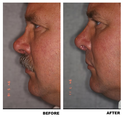 Rhinoplasty before and after photo, patient 4