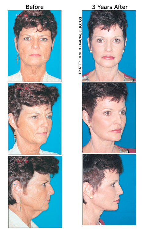 Sandra Briggs before and after