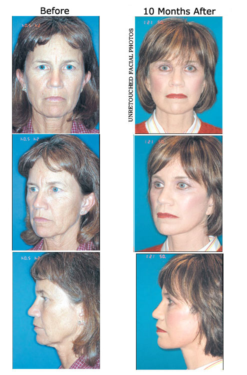 Terri Williamson before and after
