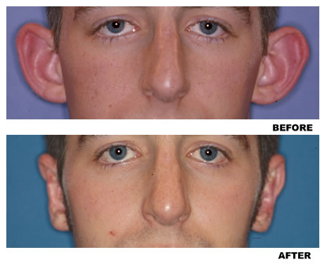 Otoplasty before and after photo 2