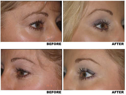 Browlift before and after photo 3