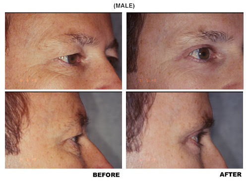 Blepharoplasty before and after photo 3