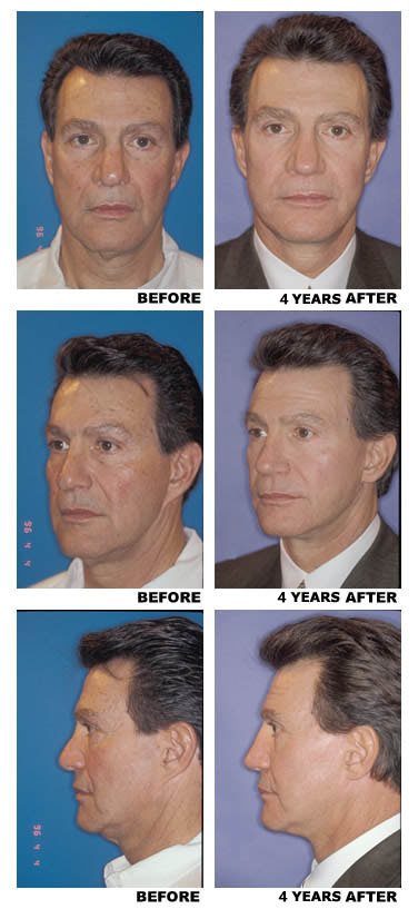 Facelift before and after photo, prior superficial facelifts
