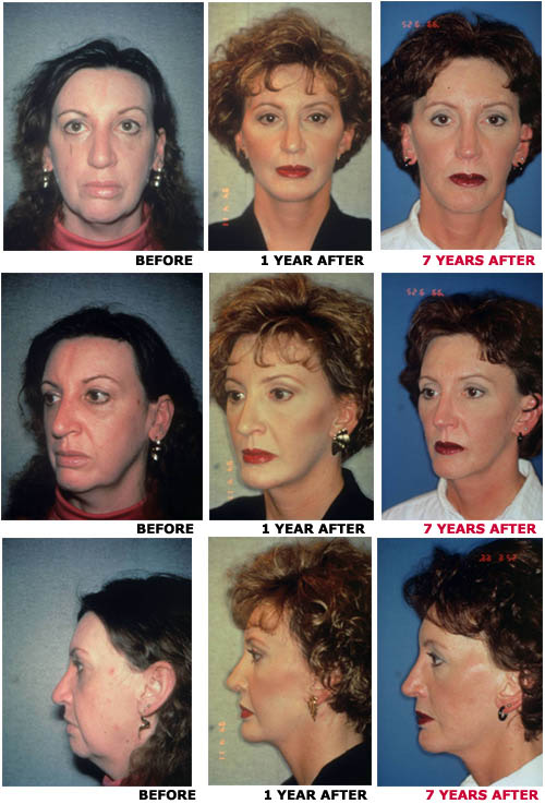 Facelift before and after photo 11