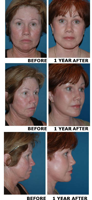 Facelift before and after photo 5