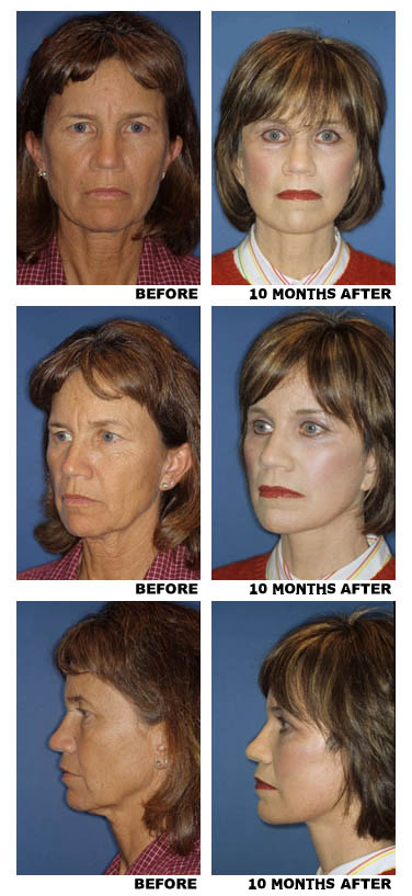 Facelift before and after photo a