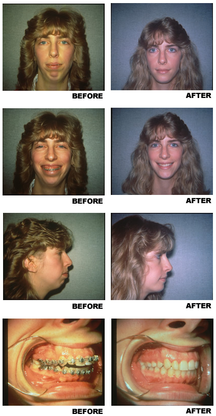 Facial bone surgery before and after photo