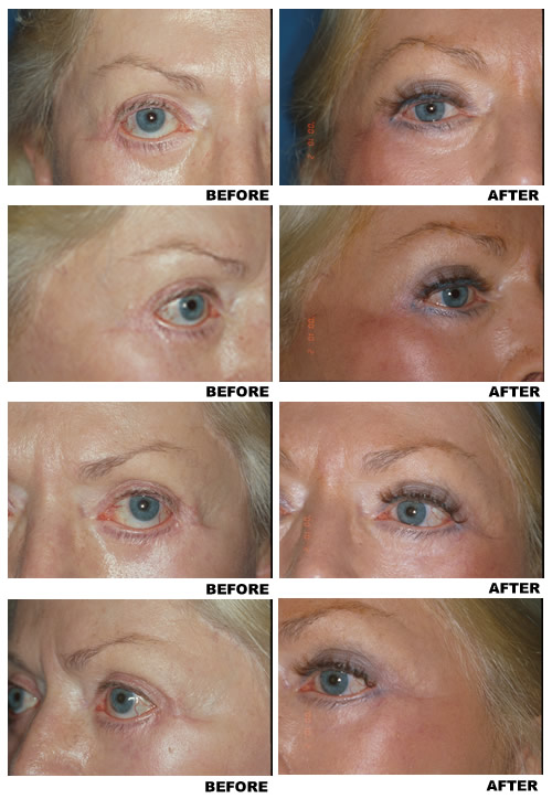Lower eyelid canthoplasty before and after photo 1