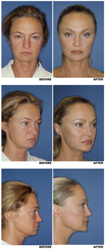Midfacelift before and after photo, patient 1