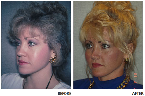 Cheek implant before and after photo 1