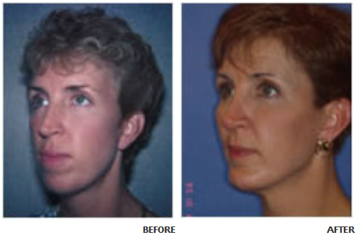 Cheek implant before and after photo 5