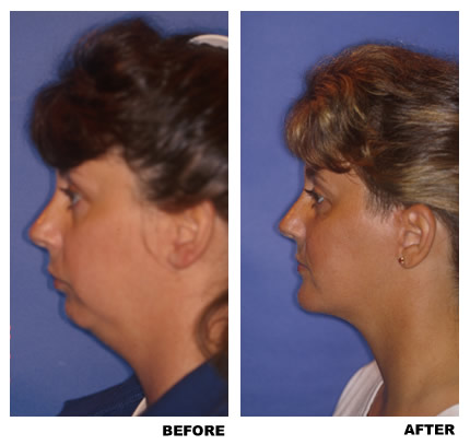 Chin implant before and after photo 2
