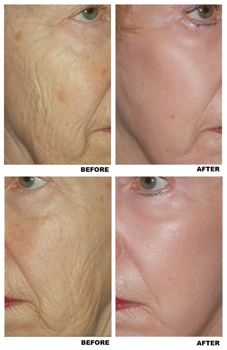 Laser skin resurfacing before and after photo 3