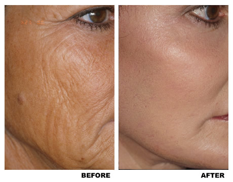 Laser skin resurfacing before and after photo 4