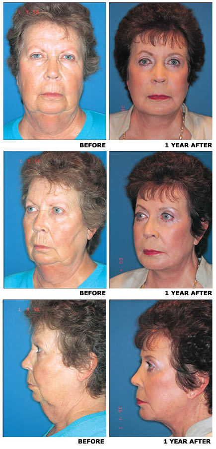 face-11