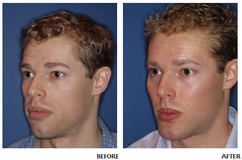 cheekbone implants men before and after